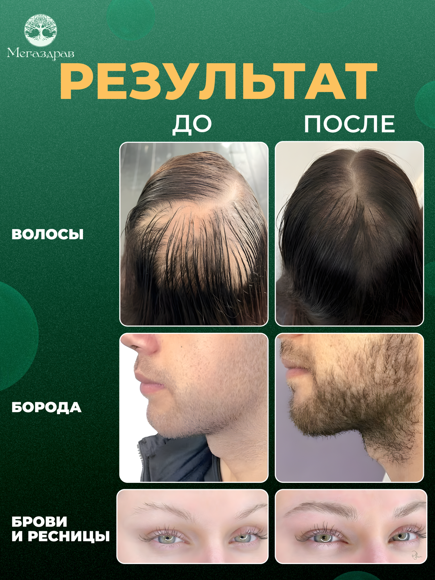 Капиксил 15% Средство для роста волос бороды и бровей / Сыворотка против облысения / Лосьон от выпадения волос — фото 1