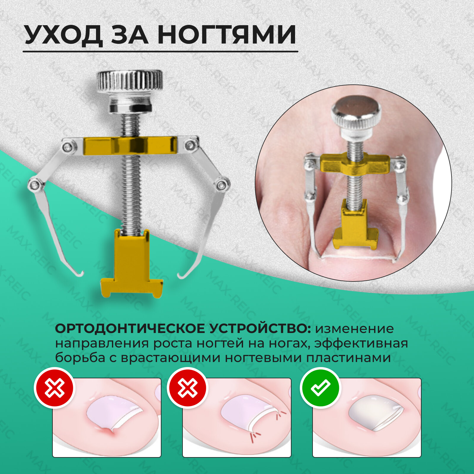 Набор для педикюра, 17 профессиональных предметов в кейсе, корректор для выпрямления вросшего ногтя, цвет черный — фото 1