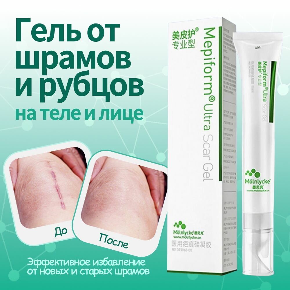 Мепиформ Mepiform Заживляющий гель от шрамов рубцов ожогов постакне