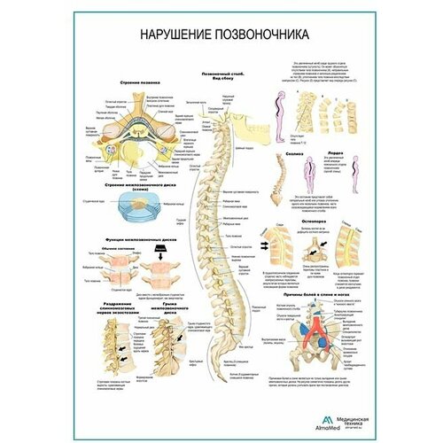 Нарушения позвоночника, плакат, глянцевая фотобумага от 200 г/кв. м, размер A1+