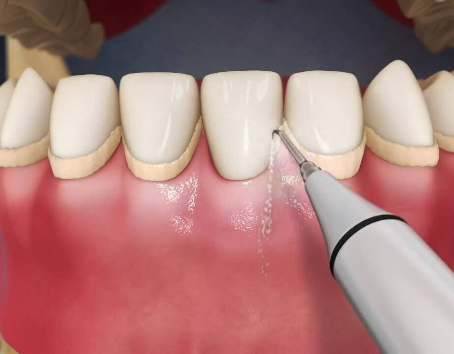 Скалер стоматологический для домашнего использования