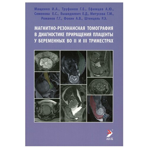 Магнитно-резонансная томография в диагностике приращения плаценты у беременных во II и III триместрах