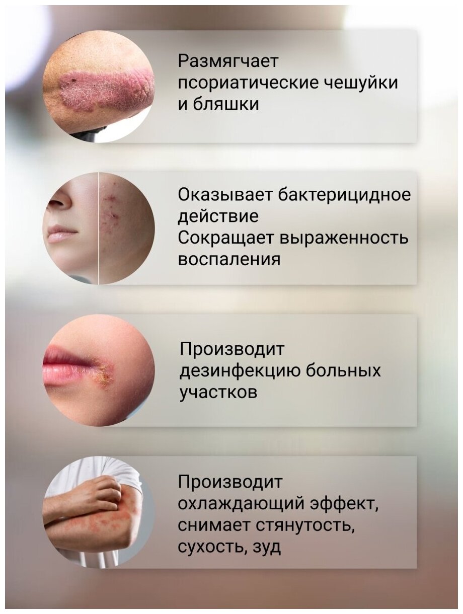 Король кожи, крем от псориаза акне, мазь от грибка ногтей, заживляющий ...