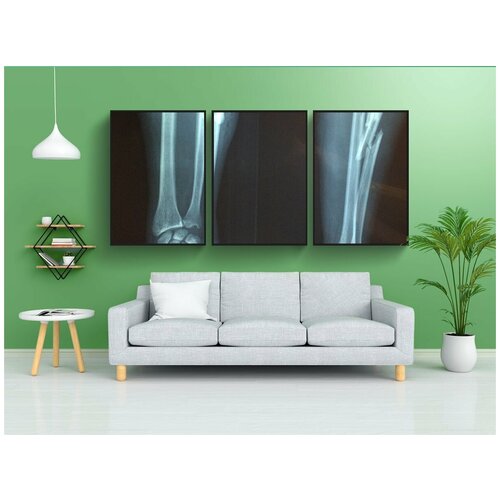 фото Набор модулных постеров для интерьера "перелом кости, рентгеновский, скелет" 60x90 см. в тубусе, без рамки lotsprints