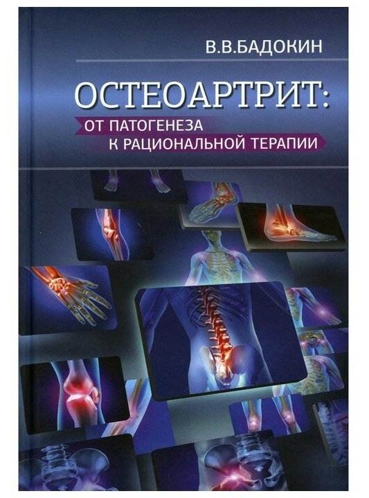 Остеоартрит от патогенеза к рациональной терапии - фото №1