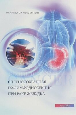 Спленосохранная D2-лимфодиссекция при раке желудка.