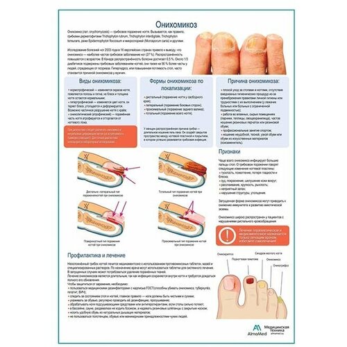 Онихомикоз медицинский плакат глянцевая фотобумага от 200 г/кв. м, размер A2+