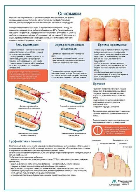 Онихомикоз медицинский плакат глянцевая фотобумага от 200 г/кв. м, размер A1+