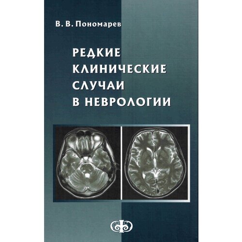 Редкие клинические случаи в неврологии (случаи из практики)