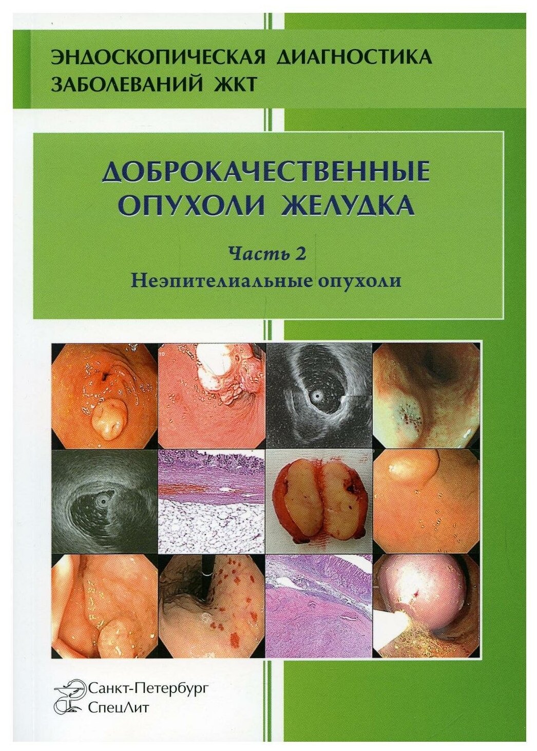 Доброкачественные опухоли желудка. Часть 2. Неэпителиальные опухоли - фото №1