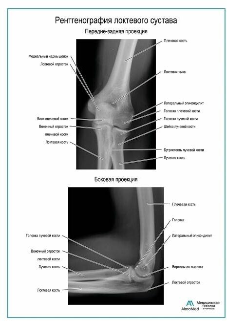Рентгенография локтевого сустава плакат, глянцевая фотобумага от 200 г/кв. м, размер A1+