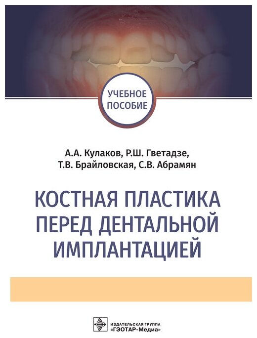 Костная пластика перед дентальной имплантацией. Учебное пособие