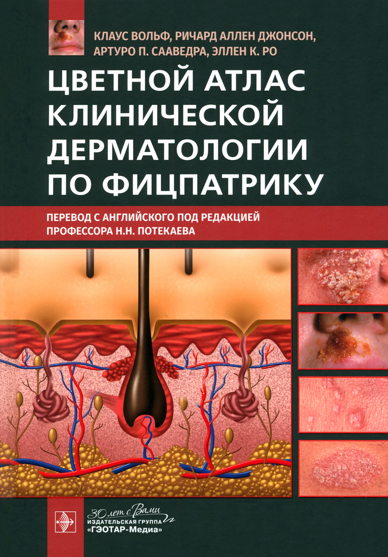 Цветной атлас клинической дерматологии по Фицпатрику - фото №14