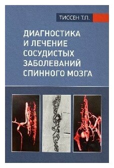 Диагностика и лечение сосудистых заболеваний спинного мозга