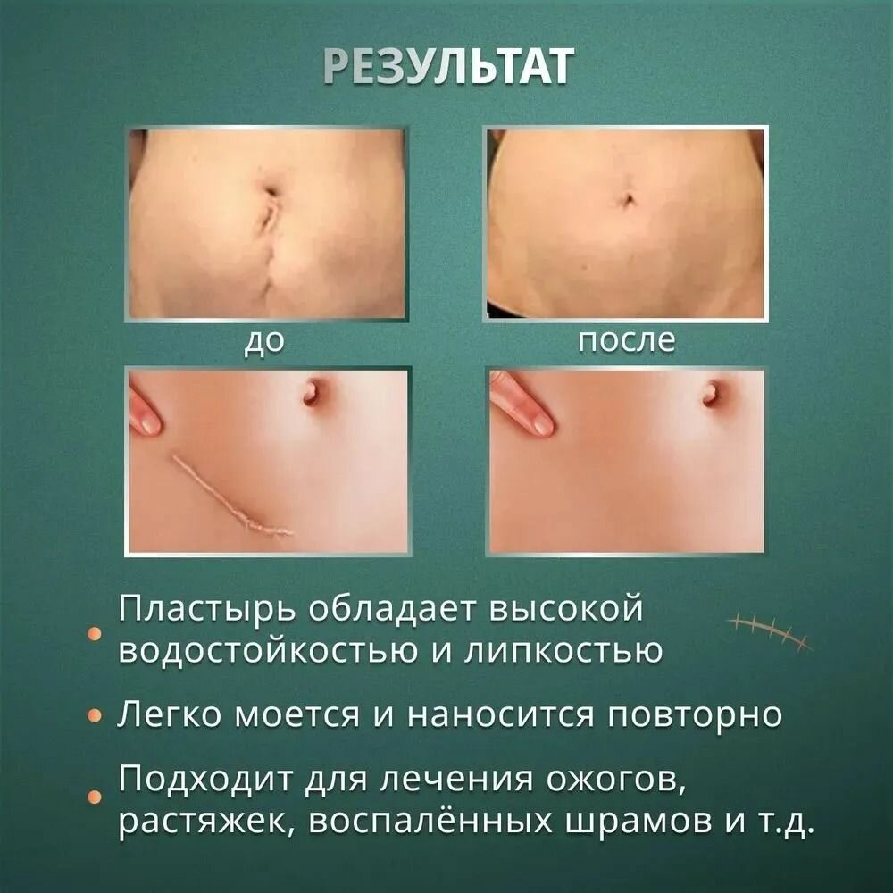 Препараты От Рубцов Пластырь силиконовый от шрамов 4х150 см. дерматикс Послеоперационный пластырь