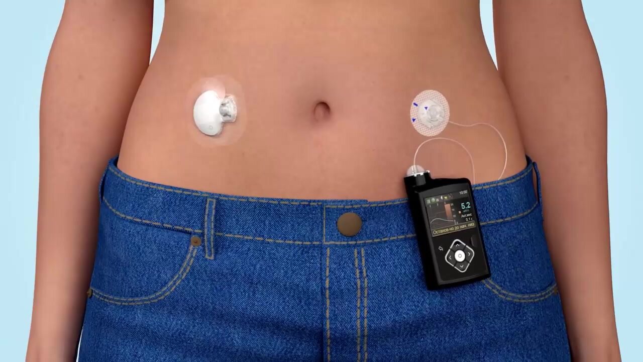 Инфузионный набор Medtronic MiniMed Quick-Set ММT-399А (Медтроник МиниМед Квик-Сет), 6 мм/60 см, 10 штук в упаковке — фото 1