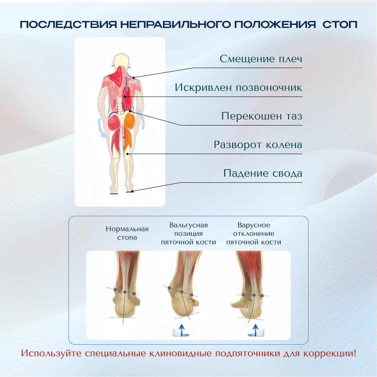 Изображение Подпяточник ортопедический MyBalance, для коррекции косолапия, гелевый, на клейкой основе, 35-39 размер, 2 шт