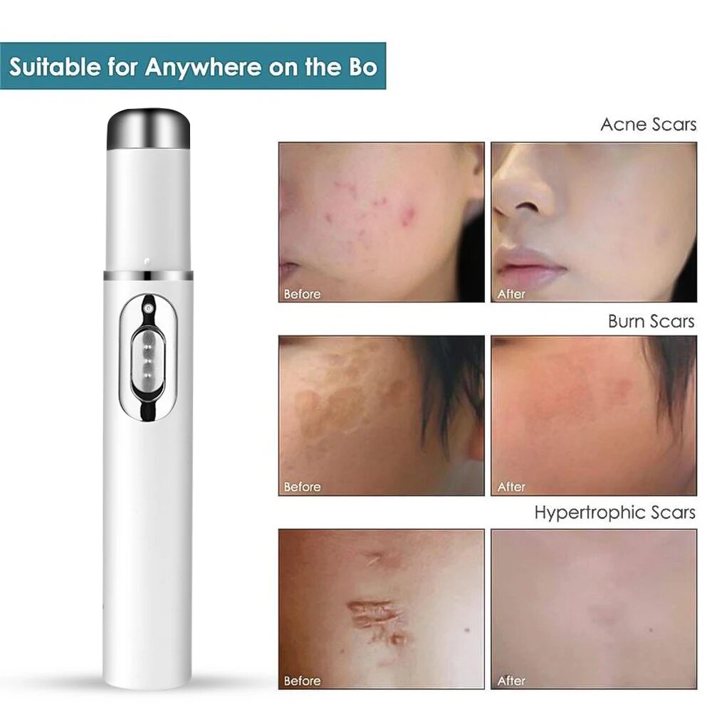 Лазерная ручка для лечения варикозного расширения вен, голубого цвета, Acne removing pen — фото 1