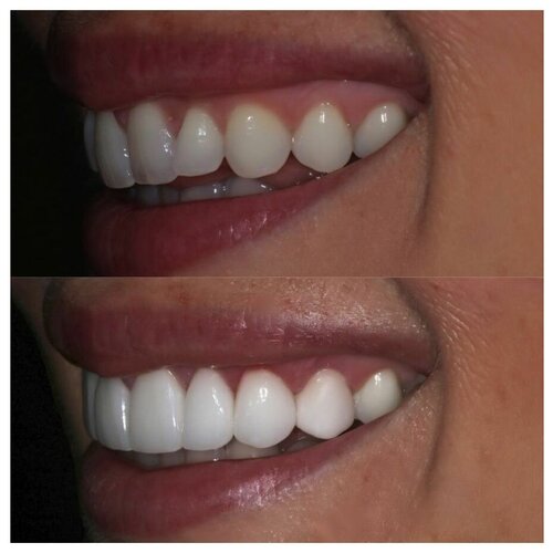 3в1 Комплекс отбеливания зубов без фтора