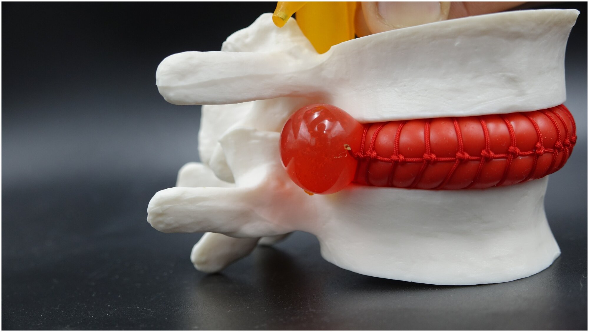 Анатомическая модель позвоночника, грыжа межпозвоночного диска. Масштаб 1: 1,5