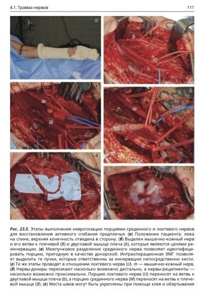 Анатомия спинномозговых нервов и доступы к ним - фото №14