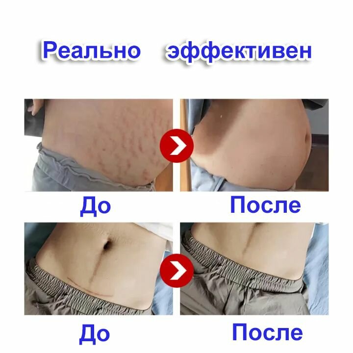 Картинки Крем от шрамов, от растяжек для беременных и от постакне для подростков, без отдушек, для лица и тела, Удаляет старые и новые шрамы 30 г