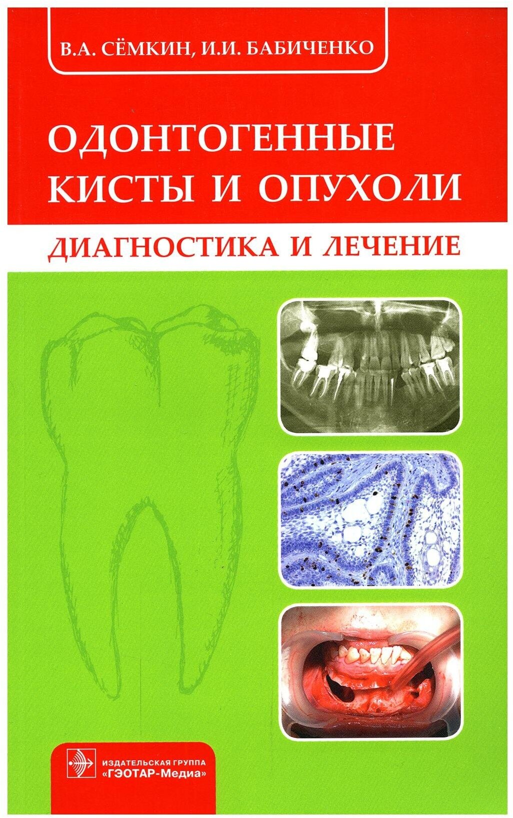 Одонтогенные кисты и опухоли. Диагностика и лечение - фото №1