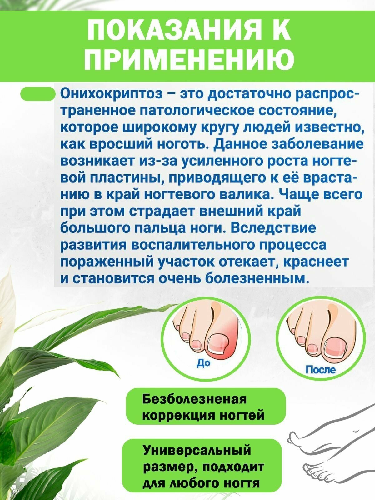 Набор педикюрный от вросшего ногтя QuisLife: Полоски-корректоры для выпрямления ногтей 10 шт — фото 1