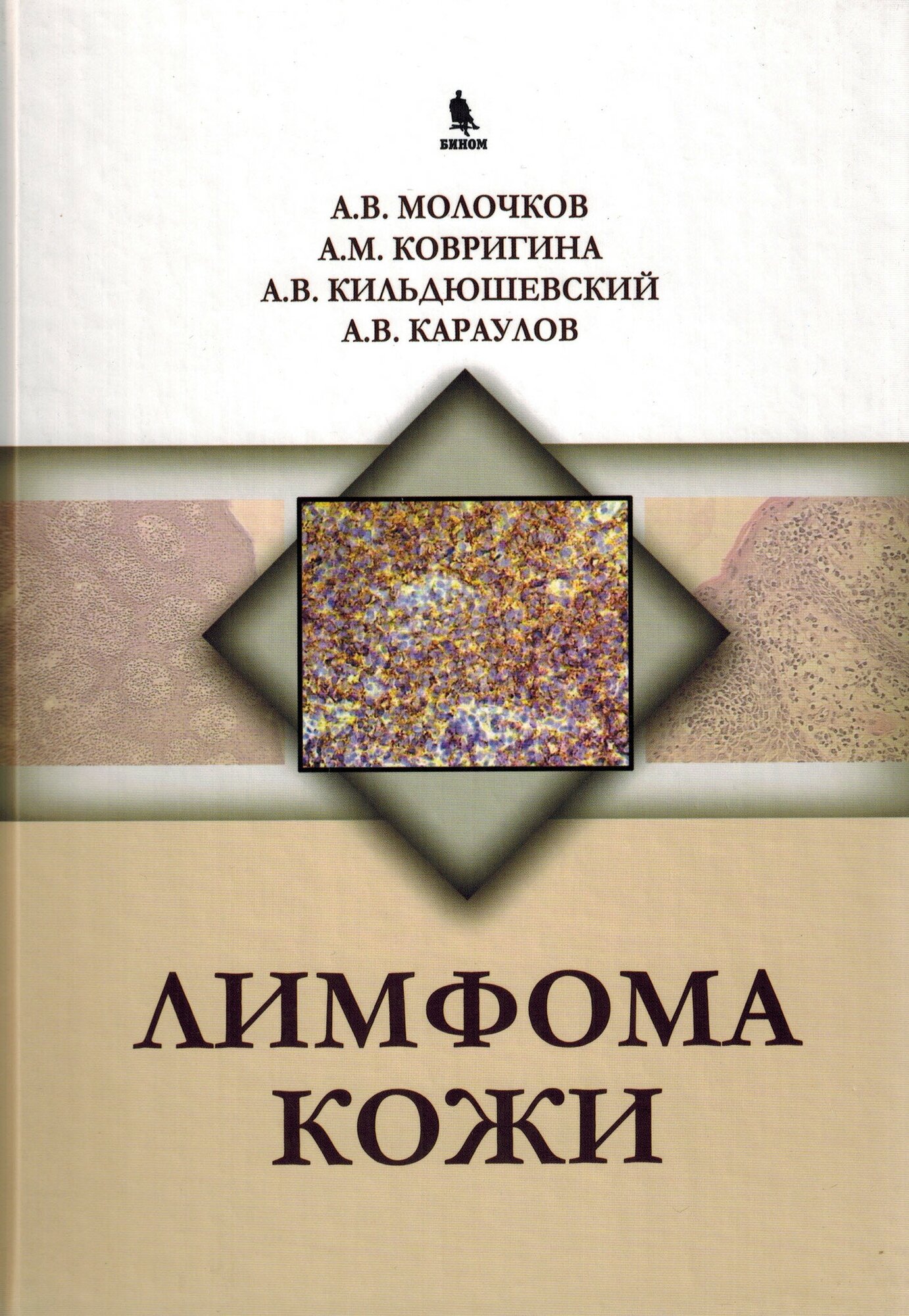 Лимфома кожи (Молочков Анатолий Владимирович, Караулов Александр Викторович, Ковригина Алла Михайловна, Кильдюшевский Александр Вадимович) - фото №1