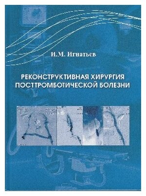 Игнатьев И. М. "Реконструктивная хирургия посттромботической болезни"