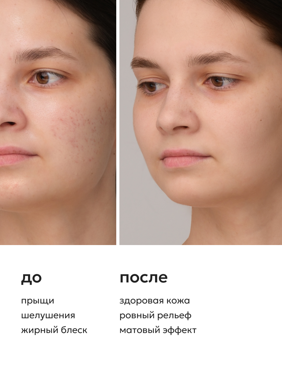 Лосьоны Для Лица Likato Professional Двухфазный увлажняющий лосьон для лица с цинком от прыщей и от черных точек. 200 мл