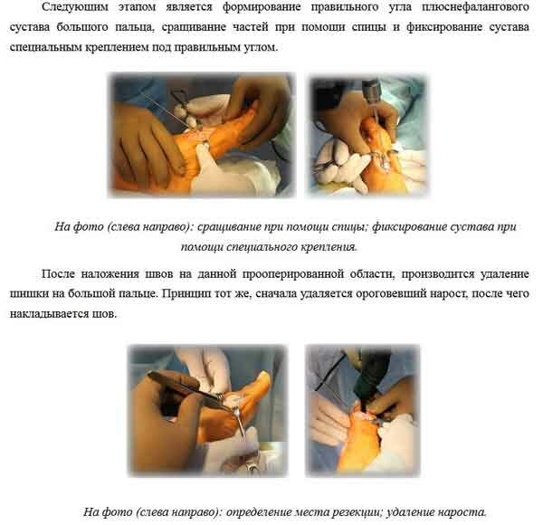 постановка подкожной инъекции фото