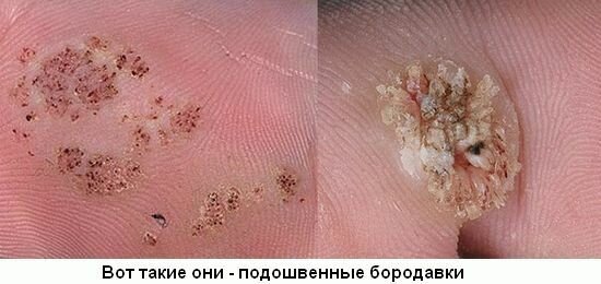 «Бородавки, виды бородавок, симптомы, фото и лечение Бородавка, виды ...