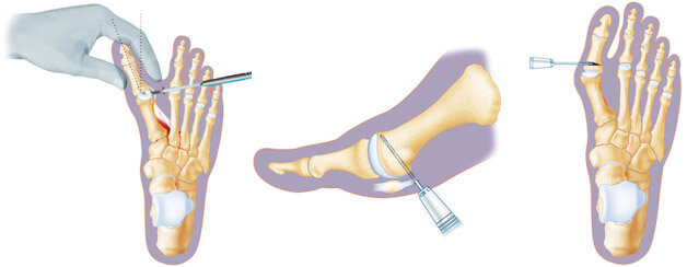 hallux valgus операция фото