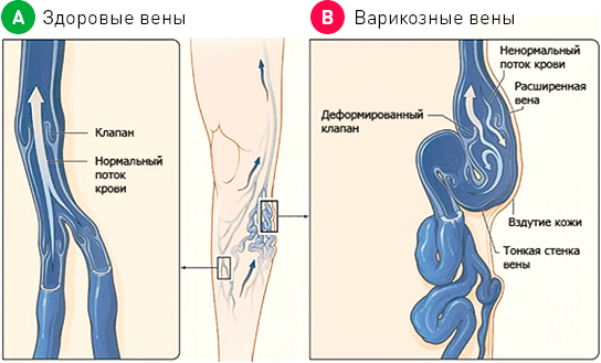 варикозное расширение вен фото