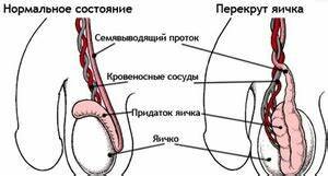 что такое перекрут яичка фото