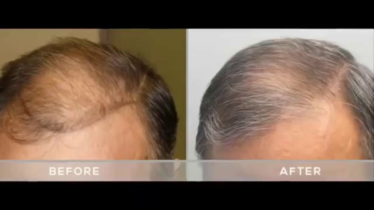 minoxidil before after фото