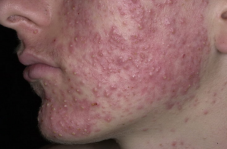 ugrevaya-sip-na-shekah-lbu-prichini