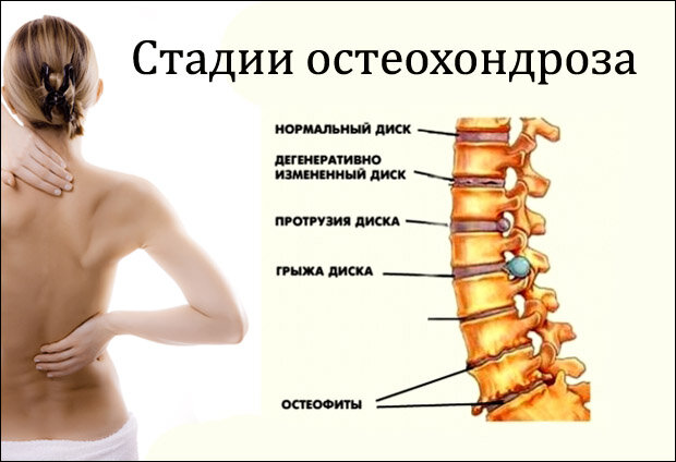 остеохондроз фото