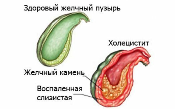 воспаление желчного пузыря фото
