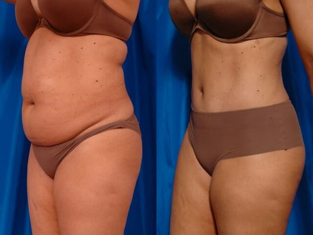 Виды липосакции живота