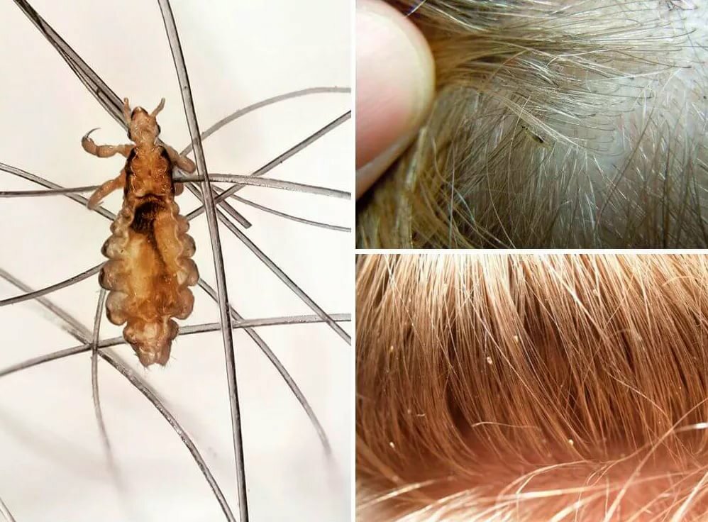 Основные способы борьбы со вшами