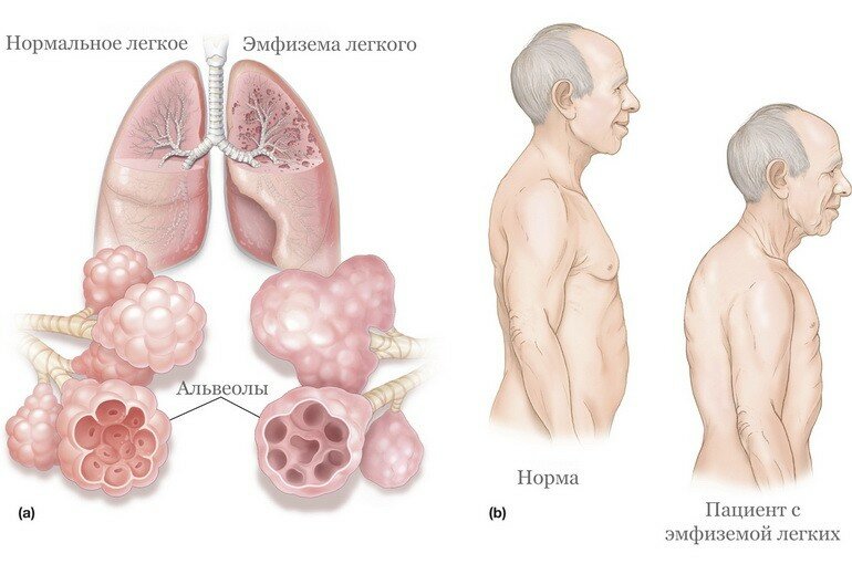 Эмфизема легких.Симптомы и лечение.