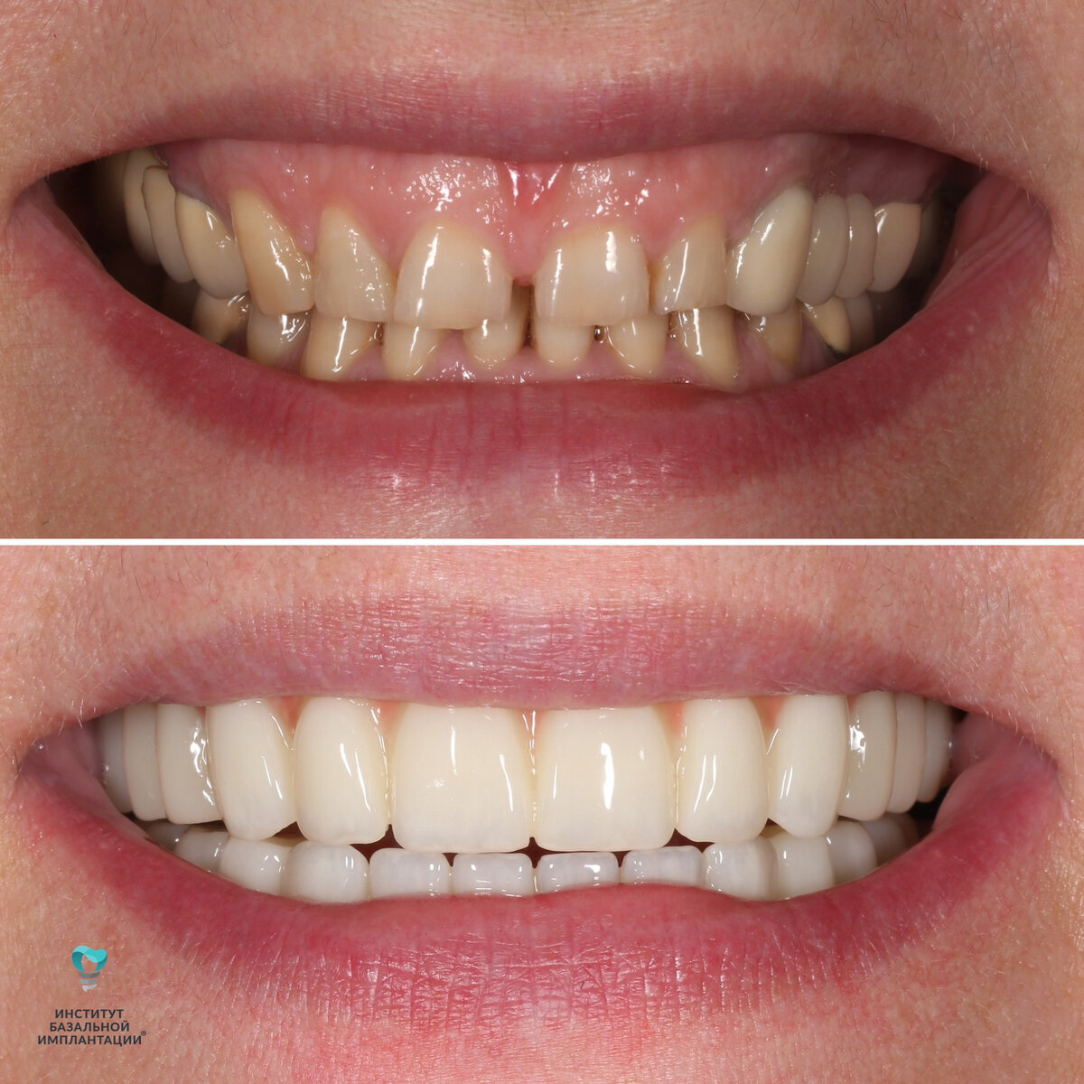 Имплантация зубов: что правда, а что вымысел?