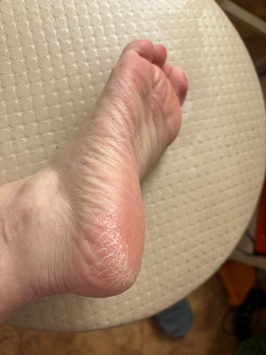 Лето близко, а пятки не подготовлены: план спасения кожи