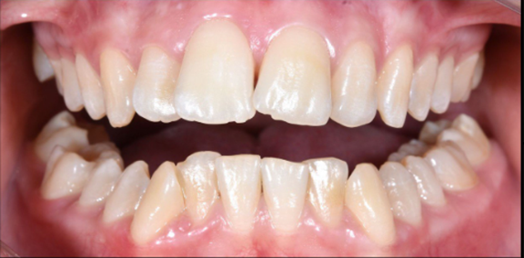 Ровные зубы за 4 месяца вместо 4 лет: показываем кейс