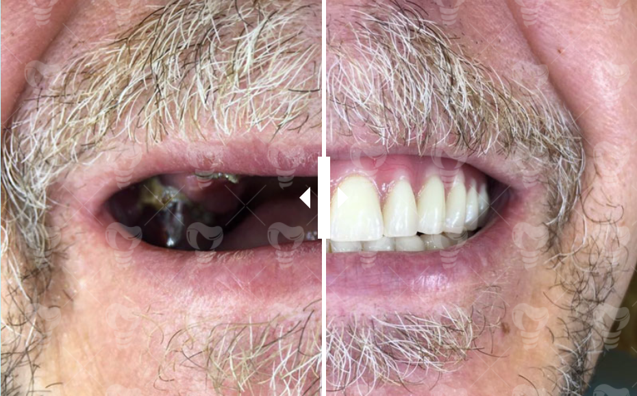 Имплантация зубов: что правда, а что вымысел?