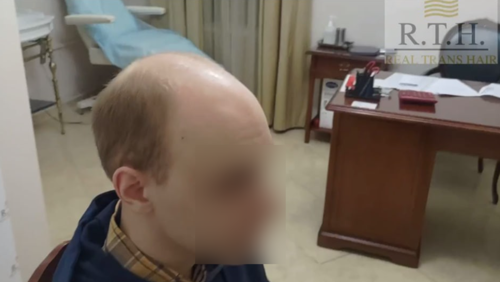 Степень облысения 5А. Как происходит пересадка волос