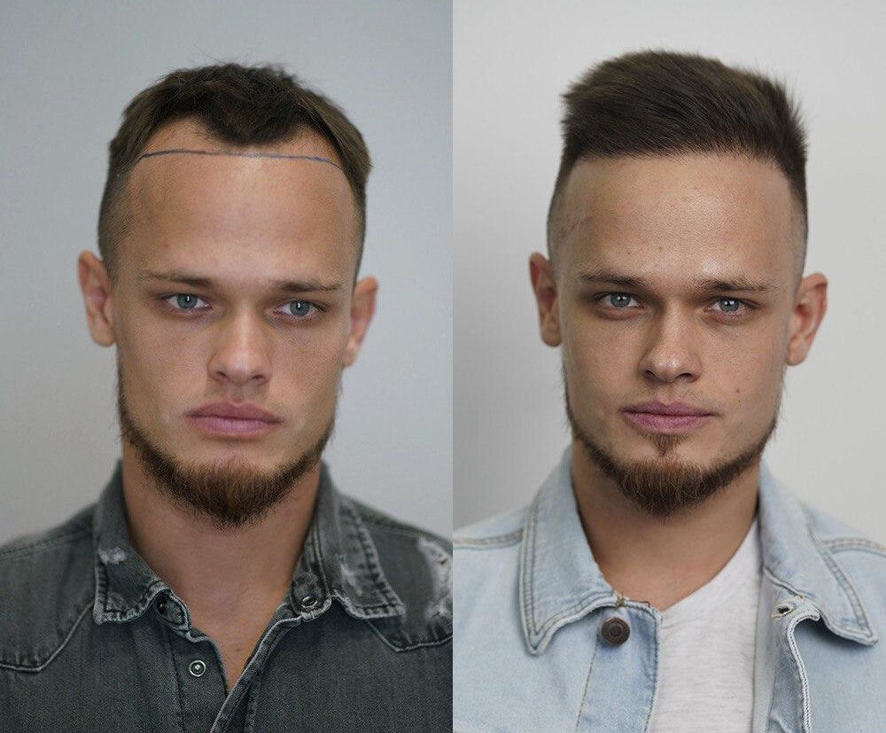 Что такое графты в пересадке волос