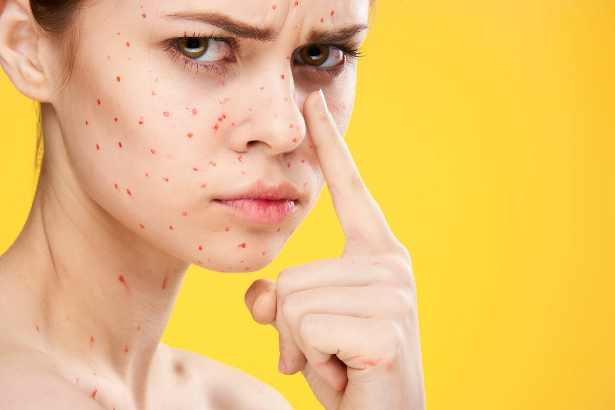 Прыщи — верхушка айсберга. Ищите причину внутри